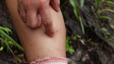 Hiker Scratching Itchy Insect Bites On Leg In Forest Stock Footage 345940133