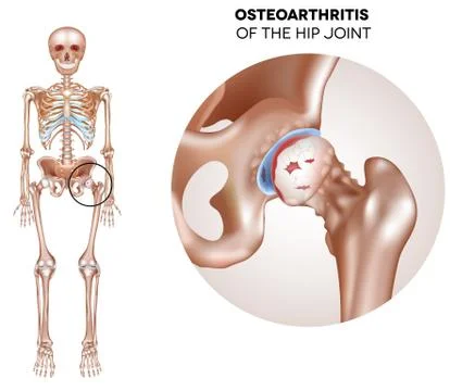 Hip Arthritis Stock Illustration
