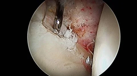  HIP ARTHROSCOPY An arthroscopy with dislocation of the hip. Labrum with m... Stock Photos