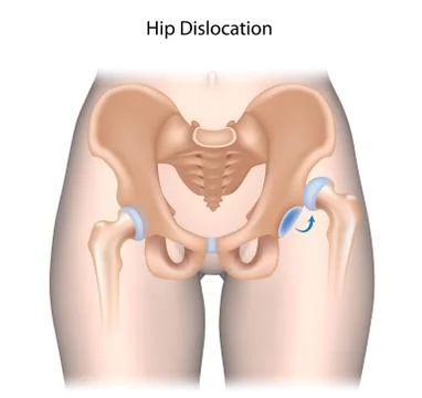 Hip dislocation anatomy unlabeled. Stock Illustration