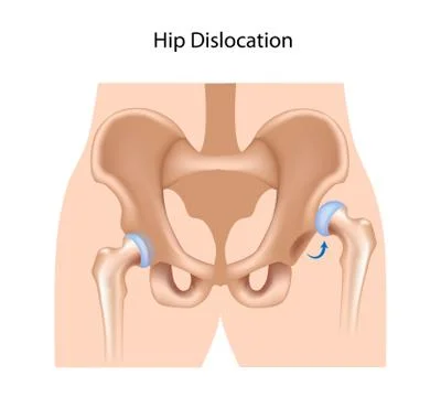 Hip dislocation Stock Illustration