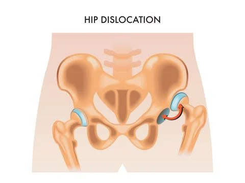 Hip dislocation Stock Illustration