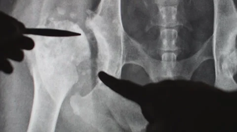 Hip Dysplasia Stock Footage 35514798