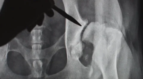 Hip Dysplasia Stock Footage 35514950