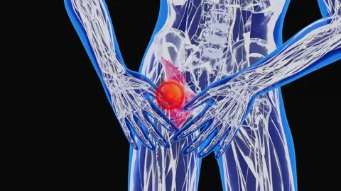 Hip Flexor Strain and Hip Muscle Sports Injury Visualization Видео 342089078