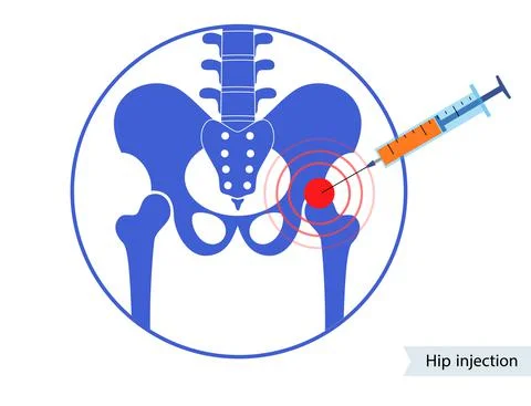 Hip joint injection Stock Illustration