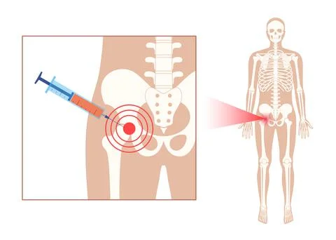Hip joint injection Stock Illustration