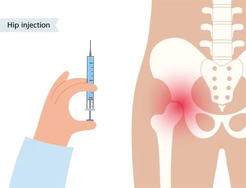 Hip joint injection イラスト素材