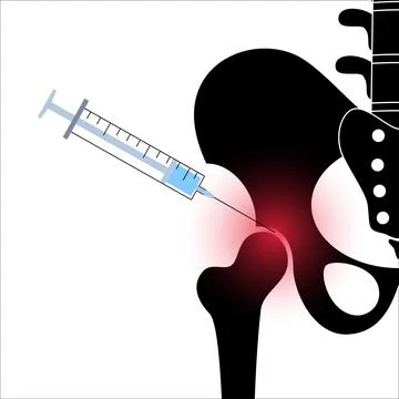 Hip joint injection Illustrazione stock