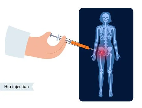 Hip joint injection Illustrazione stock