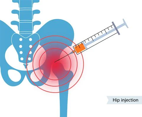 Hip joint injection Stock Illustration