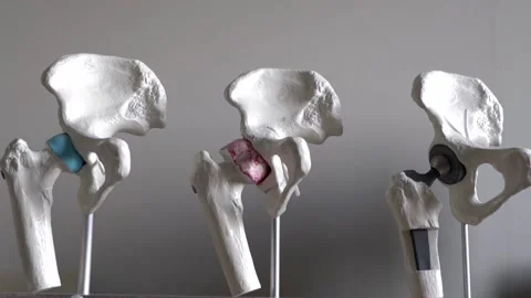 Hip joint model with implant Video stock 144634004