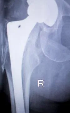 Hip joint replacement xray Stock Photos