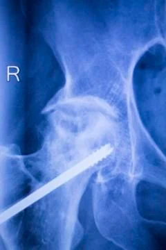 Hip joint replacement xray Stock Photos