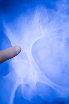 Hip joint xray scan Foto stock