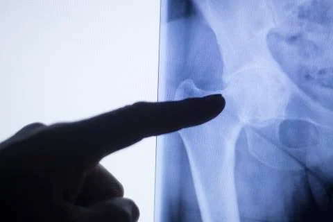 Hip joint xray test scan Stock Photos