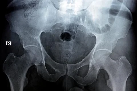Hip joints digital radiographic examination reveals normal appearance of hi.. Stock Photos