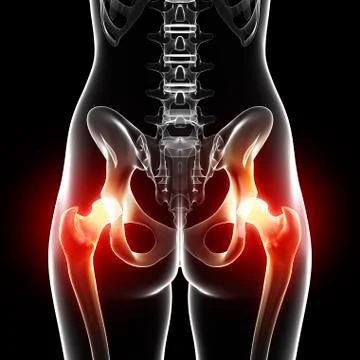 Hip pain, artwork Stock Illustration