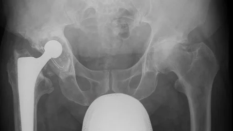 Hip prosthesis X-ray anatomy medicine Vídeo Stock 111647633