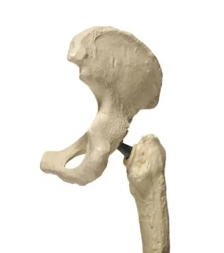 Hip replacement Stock Illustration