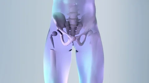 Hip replacement implant installed in the pelvis bone Stock Footage 84480291