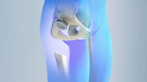 Hip replacement implant installed in the pelvis bone Stock Footage 84480310