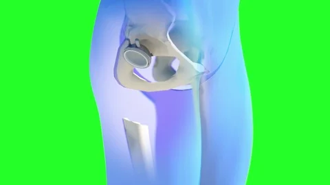 Hip replacement implant installed in the pelvis bone Stock Footage 84480318