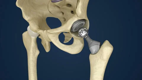 Hip replacement implant installed in the pelvis bone. Medically accurate 3D a Stock Footage 90285948
