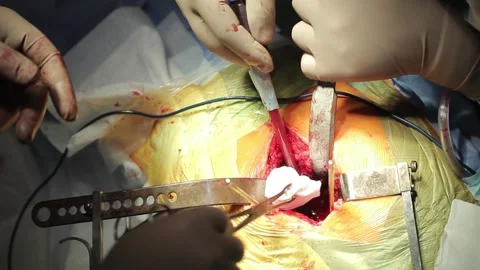 Hip Replacement Surgery Stock Footage 295844413