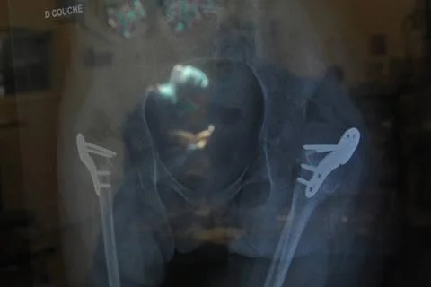  Hip replacement surgery. Hip prosthesis 016925 007  Stock Photos