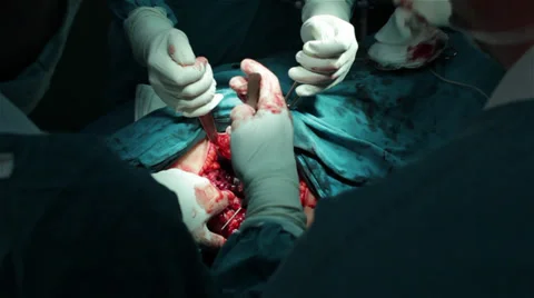 Hip surgery. Surgeons team performing operation in operating room.Wound close up Stock Footage 34617596