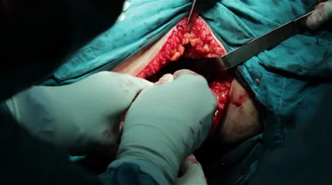 Hip surgery. Surgeons team performing operation in operating room.Wound close up 스톡 동영상 34631536