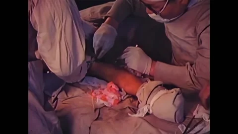 HIROSHIMA - 1945 - The two surgeons scrape away and pick debris and glass shards 스톡 동영상 312684760