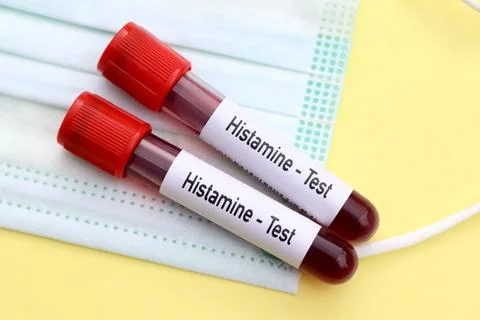 Histamine test, blood sample to analyze in the laboratory Stock Photos