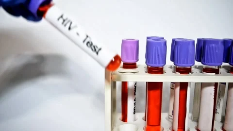 HIV virus test. AIDS Blood Test. aids test and blood tube test Stock Footage 307315613