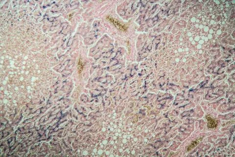 Hmosiderosis Stock Photos