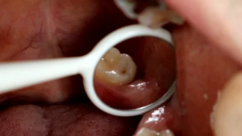 A hole in the gums caused by a wisdom tooth Stock Footage 327885643
