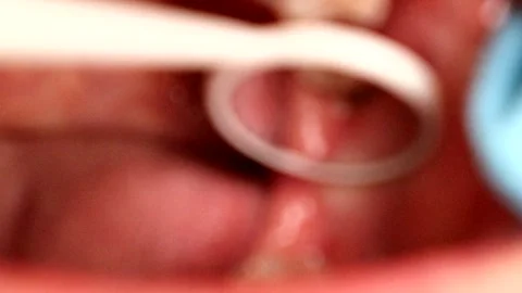 A hole in the gums caused by a wisdom tooth Stock Footage 327885761