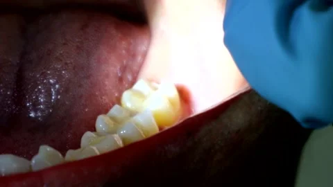 A hole in the gums caused by a wisdom tooth Stock Footage 327885827