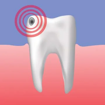 Hole in the tooth Illustrazione stock