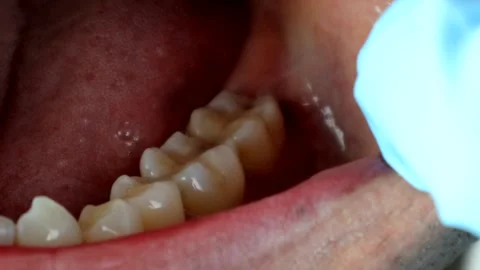 Holes in the gums caused by wisdom teeth Stock Footage 327885932