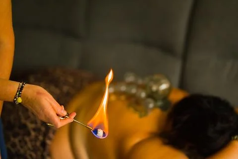 Home cupping therapy session: A naturopath uses fire cups on a woman lying .. Stock Photos