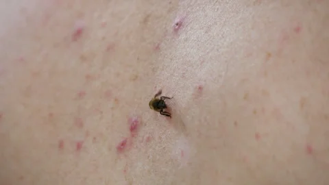 A honey bee stung a man. When bitten, the bee leaves the poison sac. Allergy to Stock Footage 244637846