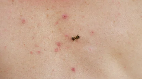 A honey bee stung a man. When bitten, the bee leaves the poison sac. Allergy to Stock Footage 245553809