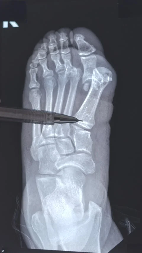 Hook-shaped deformity Video stock 314430563