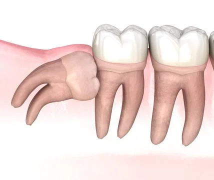 Horizontal impaction of Wisdom tooth. Medically accurate tooth 3D illustratio Stock Illustration