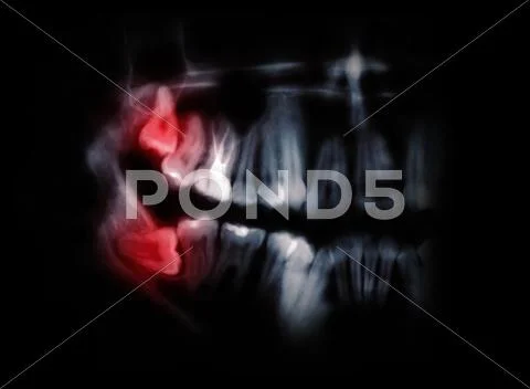 Horizontal wisdom teeth pointed out by red spots Stock Photos