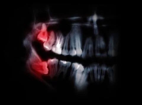 Horizontal wisdom teeth pointed out by red spots Foto stock