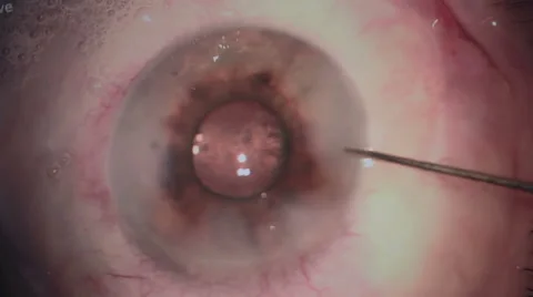 Horrible scene. Eye surgery. Cataract re... | Stock Video | Pond5