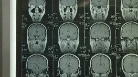 Hospital X-ray brain scan 03 Stock Footage 145820007